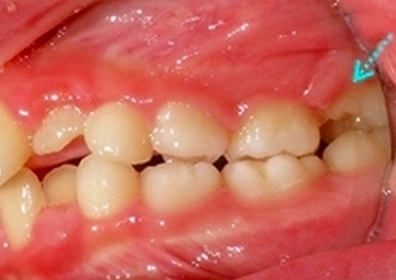 6歳臼歯が前の乳歯にひっかかって、うまく生えてこられない。　