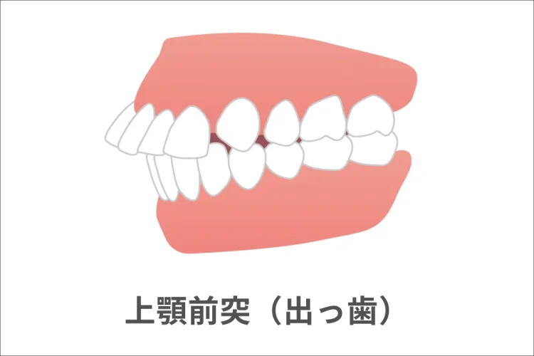 上顎前突（出っ歯）