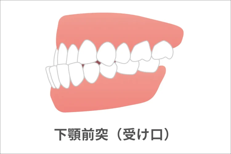 下顎前突（受け口）