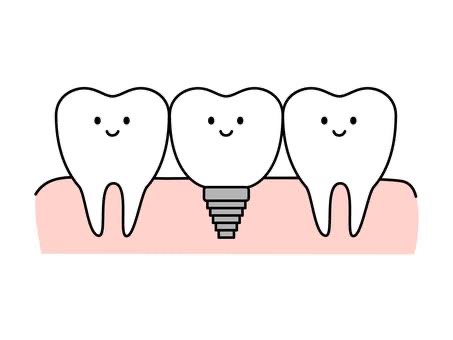 インプラントとは 画像