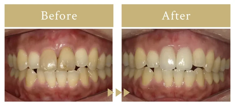 エス歯科クリニックのインプラント症例No106