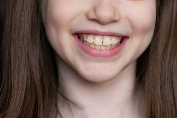 出っ歯（上顎前突）の矯正治療｜原因から費用、期間、治療法まで専門医が徹底解説 画像