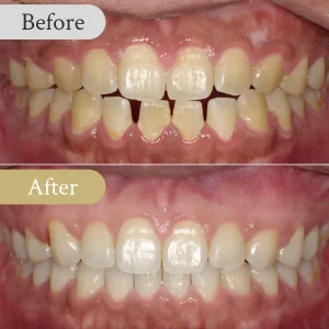 すきっ歯の歯列矯正