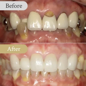 過蓋咬合の歯列矯正