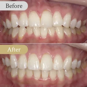 叢生の歯列矯正