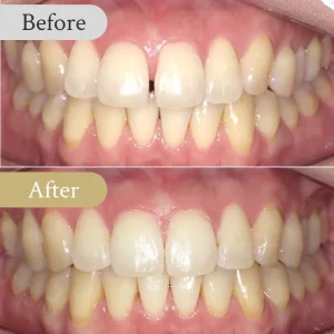 すきっ歯の歯列矯正