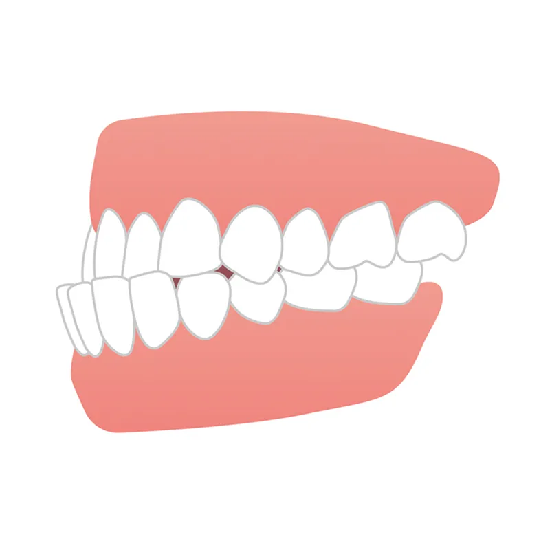 下顎前突（受け口）