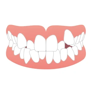 叢生（そうせい）