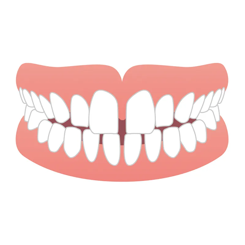 空隙歯列（すきっ歯）