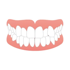 軽度の叢生（そうせい）・八重歯