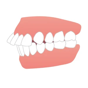 上顎前突（じょうがくぜんとつ）