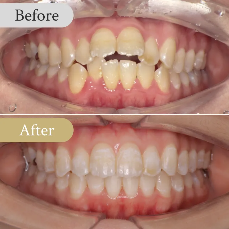 出っ歯の歯列矯正