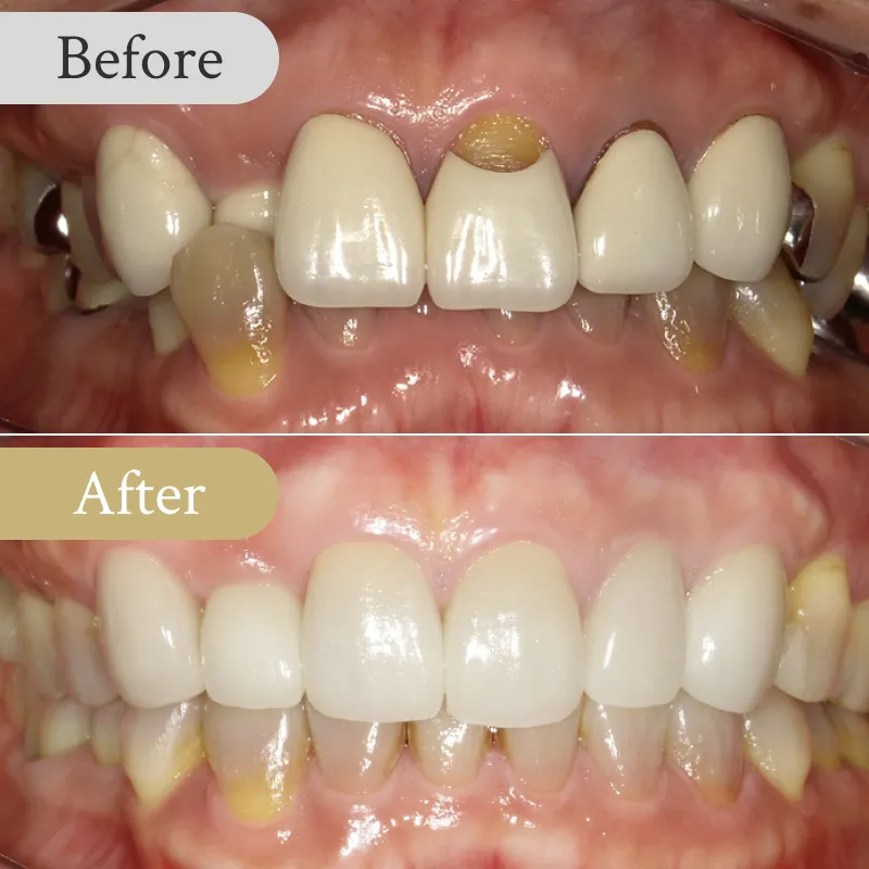 過蓋咬合の歯列矯正