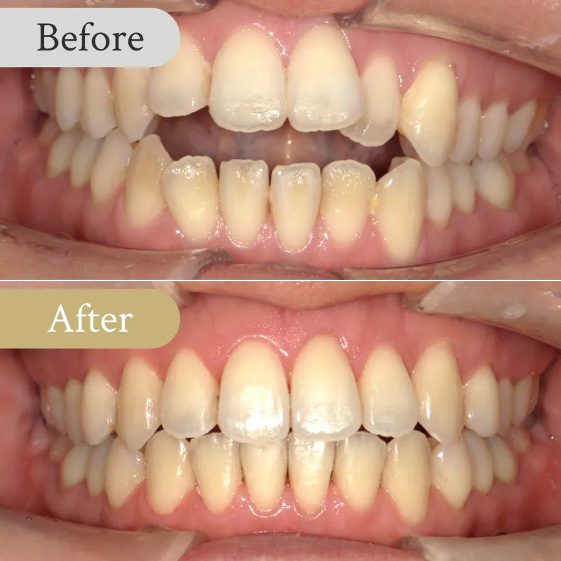 オープンバイトの歯列矯正