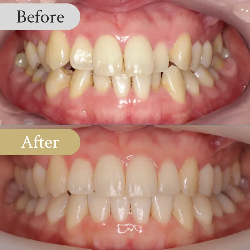 八重歯の歯列矯正