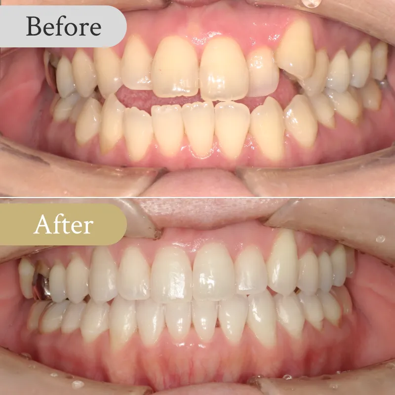 受け口の歯列矯正